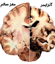 روز جهانی آلزایمر 